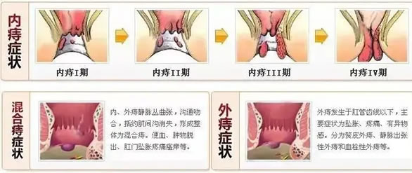 内痔疮最佳的自愈方法(内痔疮用什么药可以根治)